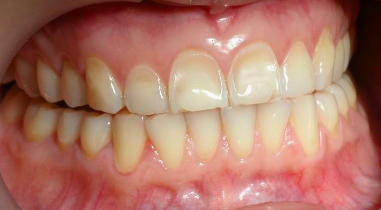 Erosion, dünner Zahnschmelz, flächige Zahn-Defekte durch Säureeinwirkung